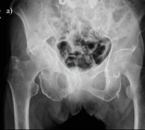 Real AP pelvis radiograph showing a femoral neck fracture in an elderly fragility-fracture case.
