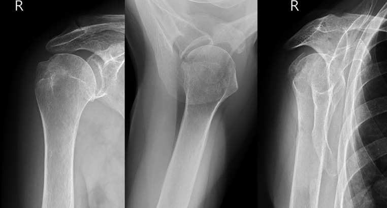 Real shoulder radiographs showing a proximal humerus fracture in an elderly woman.